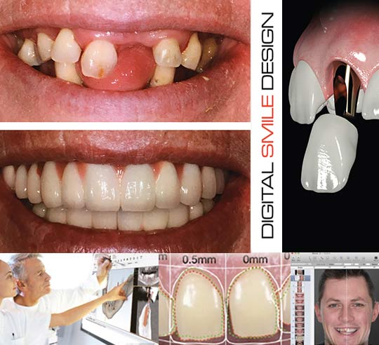 Digital Smile Design After having Digital Smile Design treatment