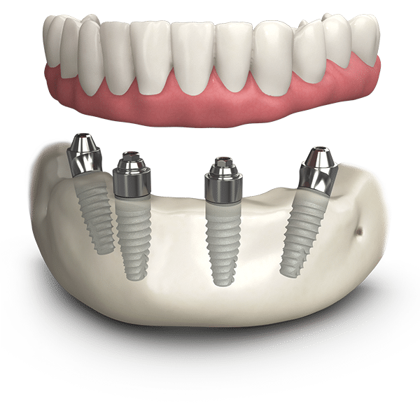 dental-implants-reading