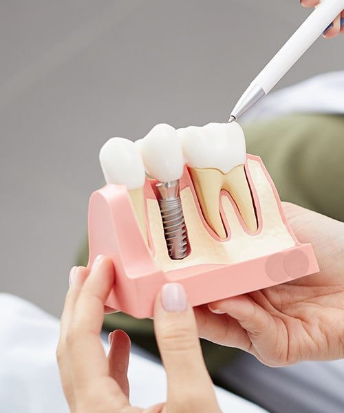dental-implants-reading-12