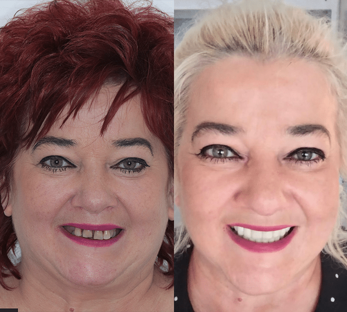 all on 4 dental implants all on 4 dental implants Birmingham